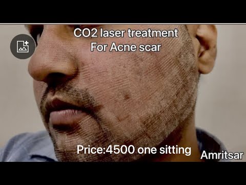 I got franctional CO2 Laser Treatment for Acne Scars | first sitting | Before After Results |