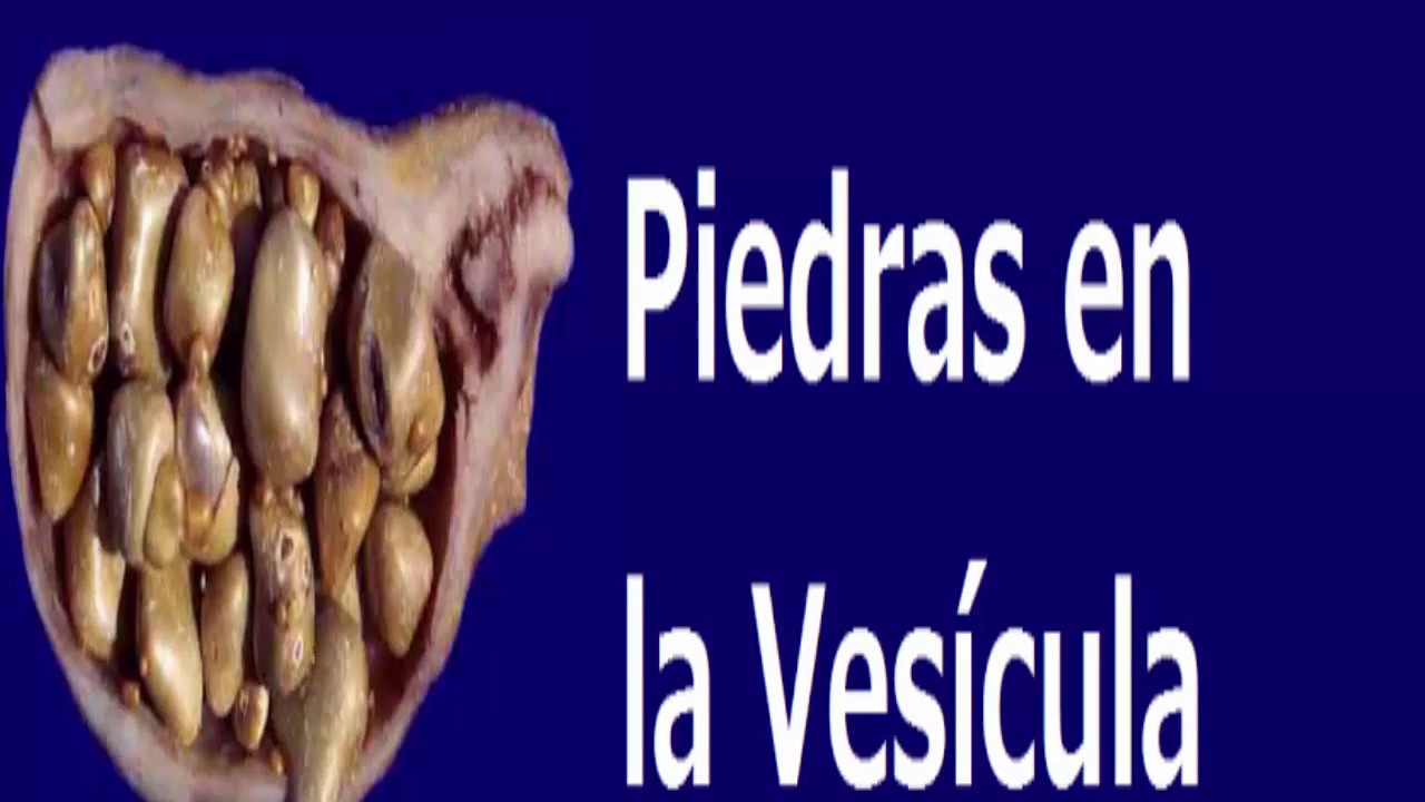 Receta natural para eliminar las Piedras