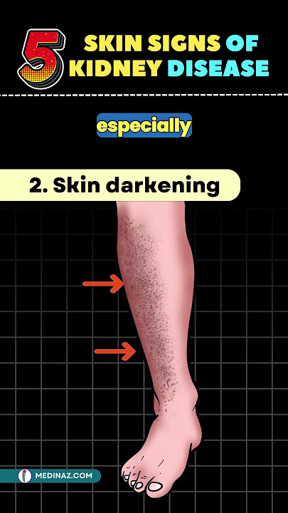 5 Weird Skin Signs of Kidney Disease | Chronic Kidney Disease #shortsfeed #kidney #kidneydisease