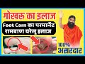 पैर के तलवे में गोखरू का इलाज|Gokhru ka gharelu Ilaj|Foot Corn causes and treatment |Pair me deal