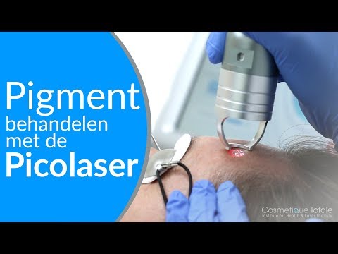 PIGMENTVLEKKEN VERWIJDEREN ( PICOLASER ) Voor Pigment donkere huid, MELASMA en Zwangerschapsmasker