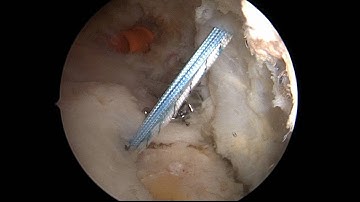 Rotator Cuff Repair Surgery - Suture Anchor