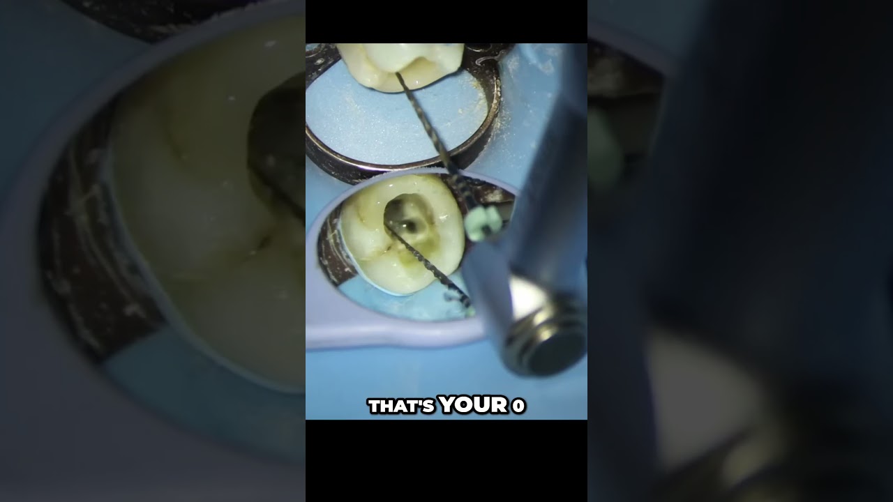 Dental Work Secrets  Mastering Apex Locator Readings for Perfect Root Canals