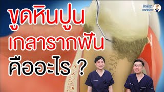 ขูดหินปูนกับเกลารากฟันต่างกันอย่างไร ?  | คลายปัญหาฟันกับหมอโชค