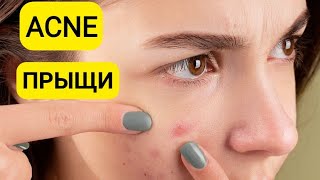 ACNE | ПРЫЩИ