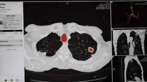 VeranSpin Lung Nodule VD