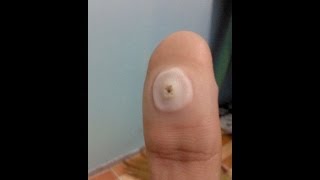 Pagtanggal Ng Kulugo Gamit Ang Salicylic Acid Pagtanggal Ng Kulugo Gamit Ang Salicylic Acid
