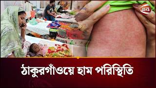ঠাকুরগাঁওয়ে হাম সংক্রমণের সর্বশেষ পরিস্থিতি  | Measles Outbreak |  Ham | Channel 24