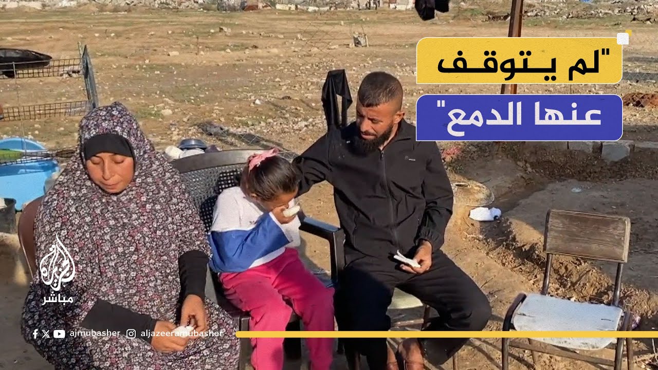 تقاسي الألم.. معاناة طفلة حرمت من يدها