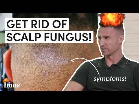 Video: 3 sätt att växa tillbaka håret efter en svampinfektion i hårbotten