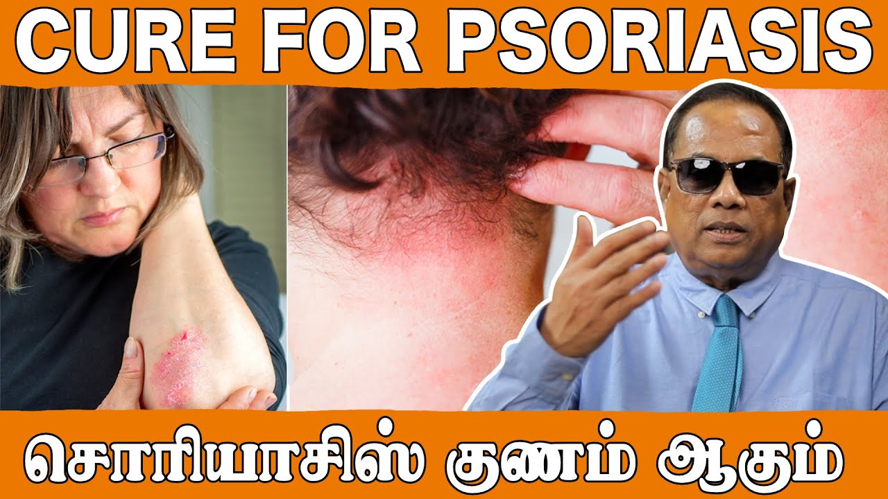 சோரியாசிஸ் குணம் ஆகும் (Cure for psoriasis) _ Dr. C.K.Nandagopalan