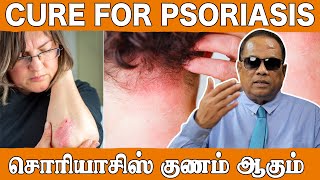 சோரியாசிஸ் குணம் ஆகும் (Cure for psoriasis) / Dr. C.K.Nandagopalan