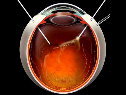 ቪዲዮ: Medicare pars plana vitrectomy ይሸፍናል?