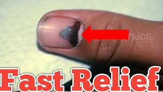 Finger Jammed Fast Relief & Cure