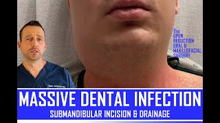MASSIVE TOOTH INFECTION | DENTAL ABSCESS DRAINAGE