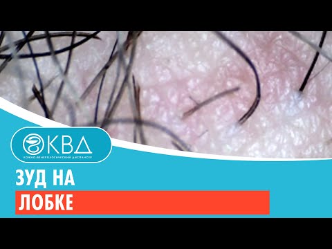 Зуд на лобке. Клинический случай №62