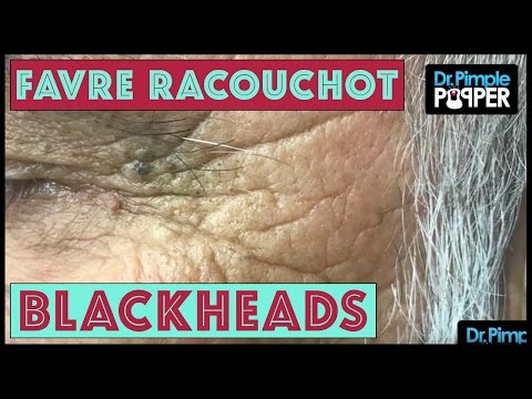 Favre-Racouchot Type Blackheads
