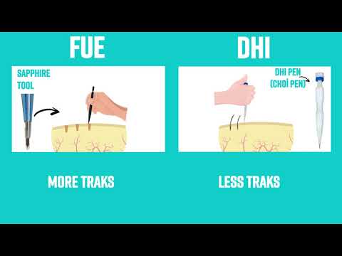 DHI Vs. FUE
