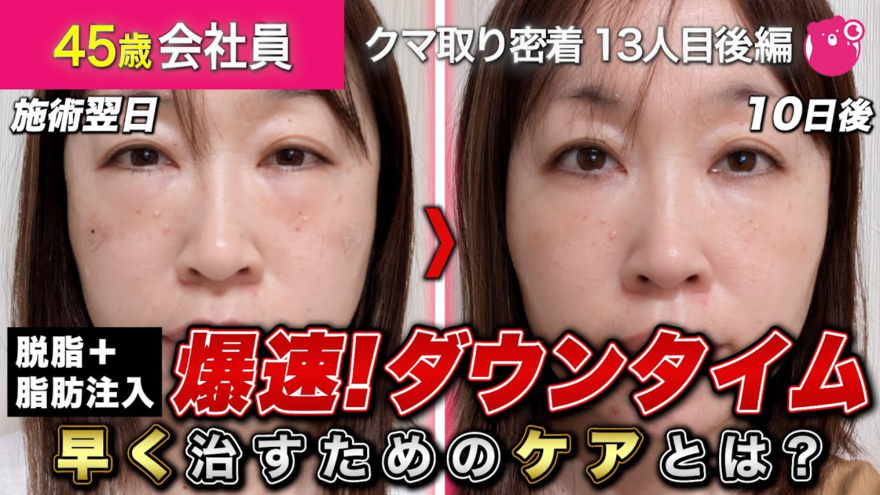 【目の下のクマ取り】ダウンタイムが気になる方はご覧あれ！ケアについても紹介【クマ取り密着13人目後編】#目の下のたるみ取り #美容整形 #湘南美容クリニック