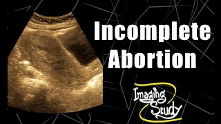 Incomplete Abortion || RPOC || Ultrasound || Case 134