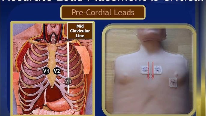 12 lead ecg placement mnemonic