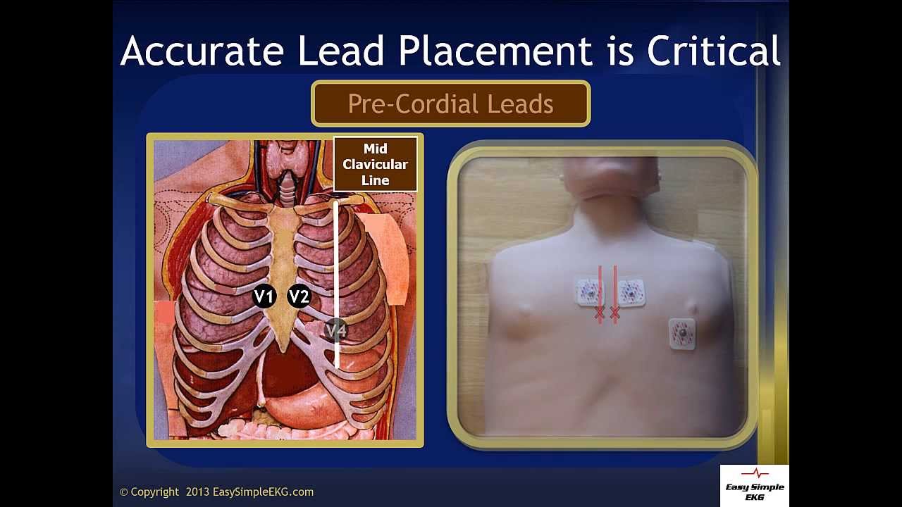 EKG Lead Placement - YouTube