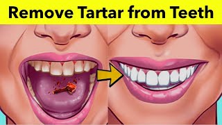 3 Natural Ways to Remove Tartar from Teeth at Home | How to Remove Plaque in Five Minutes