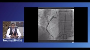 Case review: Surprising result of iFR Co-registration of the RCA and PDA with Dr. Sayan Sen
