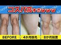 【断言します】家庭用脱毛器と医療脱毛で迷ったらおすすめはこっち