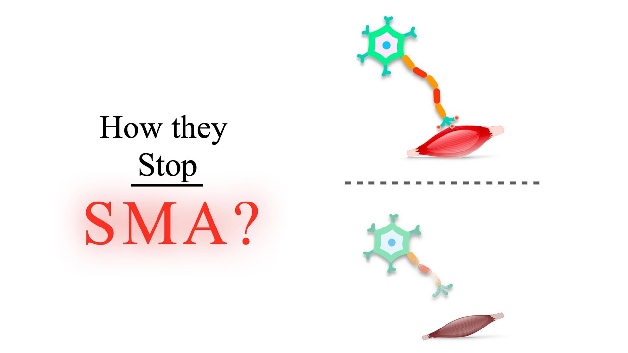 Две стратегии лечения спинальной мышечной атрофии (СМА) I. Важные детали