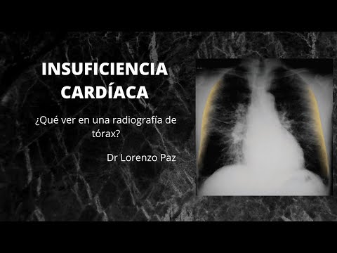 Video: Acumulación De Líquido En Los Pulmones (no Debida A Una Enfermedad Cardíaca) En Los Gatos