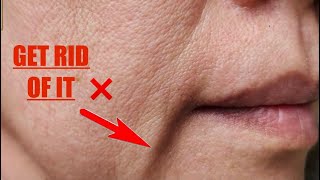 Get Rid Of Marionette Lines With Deep Mage Methods