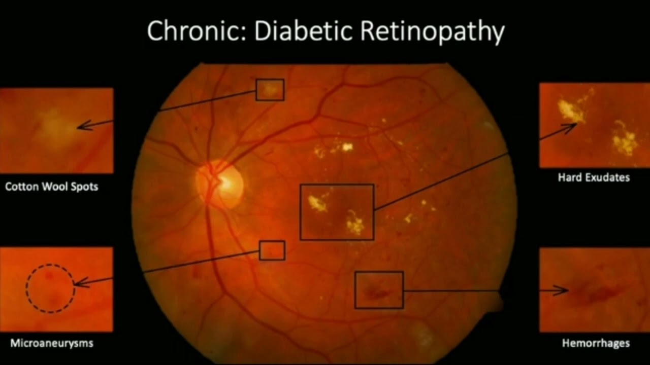 Diabetic Retinopathy in tamil