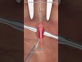 Trigger finger release surgery #motivation #doctor #epicmusicword