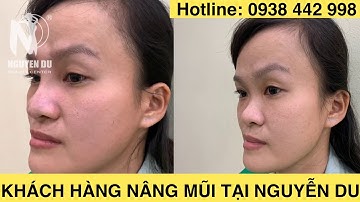 CẢI THIỆN CHIẾC MŨI THẤP MANG ĐẾN 1 CHIẾC MŨI TỰ NHIÊN, HÀI HÒA KHUÔN MẶT