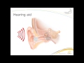 BAHA  Hearing Implant