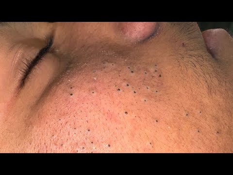 Amazing New Beauty Routine for Blackhead Removal !!
