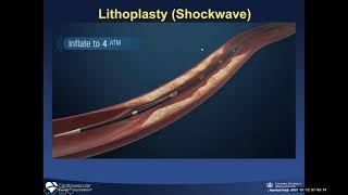 Current status of Lesion Modification, Dr. Jeffrey Moses