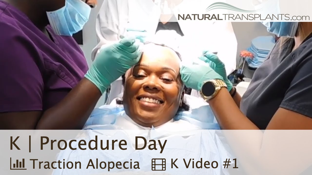 fue hair transplant month by month African American Hair Transplant After Thinning From Braids | Dr. Harold Siegel (K)