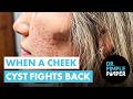 When A Cheeky Cyst Fights Back When A Cheeky Cyst Fights Back