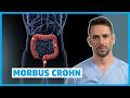 Morbus Crohn verstehen: Ursachen, Symptome, Diagnose &amp; Therapie | DocTommy Mp3 Song