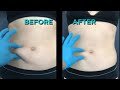 Could This Body Tightening Procedure Replace the Tummy Tuck?