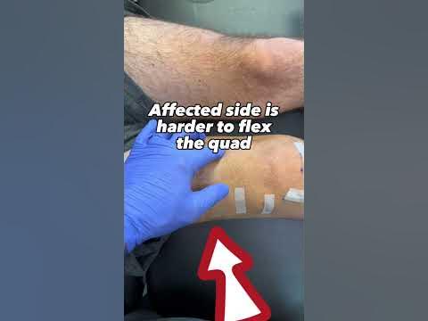 Arthrogenic Muscle Inhibition (AMI) Following ACL-Reconstruction