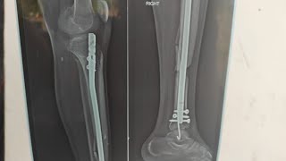 Tibia Fibula Patella Femur Fracture Fighters Live Chat group discussion ||We have to win this war