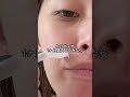 ほうれい線や首のシワが気になる人絶対に見てください!!️ #肌質改善 #シワ改善 #ほうれい線 #首のシワ #北海道PDRMクリーム # pr