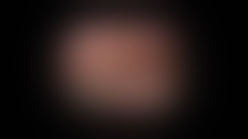 LW VIDEO 7 Acute cholecistitis with intraoperative cholangiography and transcistic drain