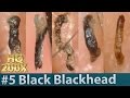 #5 Black Blackhead - Squeezing Blackheads | 黒い角栓を押し出し除去