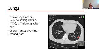 Inflammatory myopathies- an evolving spectrum of disease