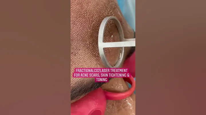 FractionalCO2las...  Treatment for Acne Scars| Der...