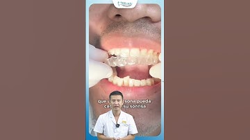 Niềng Invisalign Thay Đổi Như Nào Sau Khi Niềng | Bác Sĩ Yên